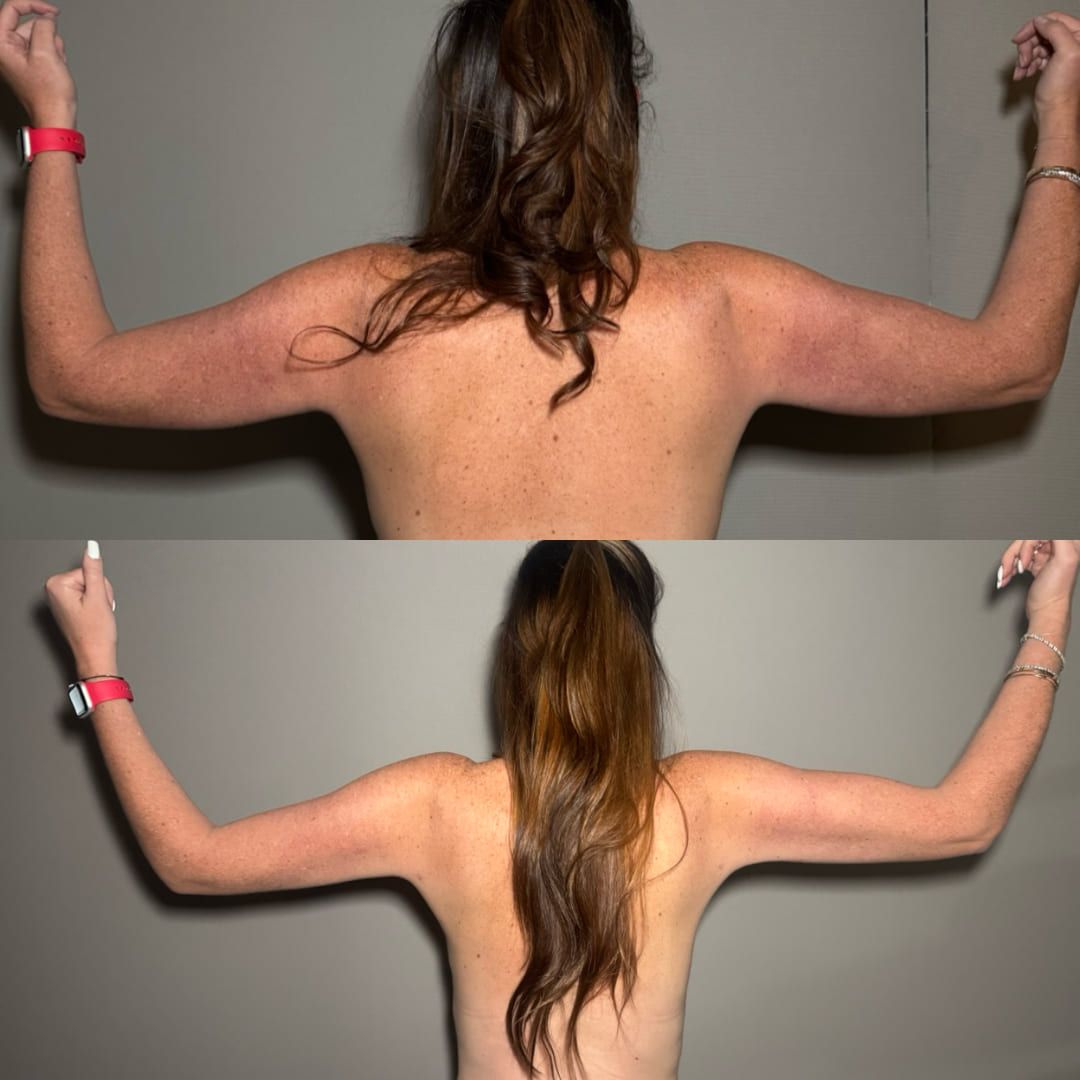 Real arm lift result by Dr. Castellanos