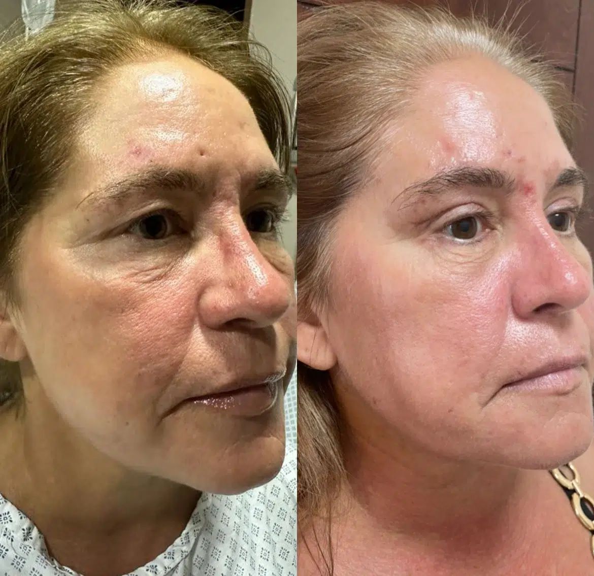 Real blepharoplasty result in Zapopan by Dr. Castellanos