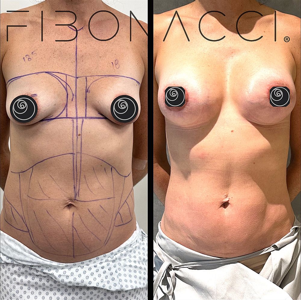Real breast augmentation result by Dr. Castellanos