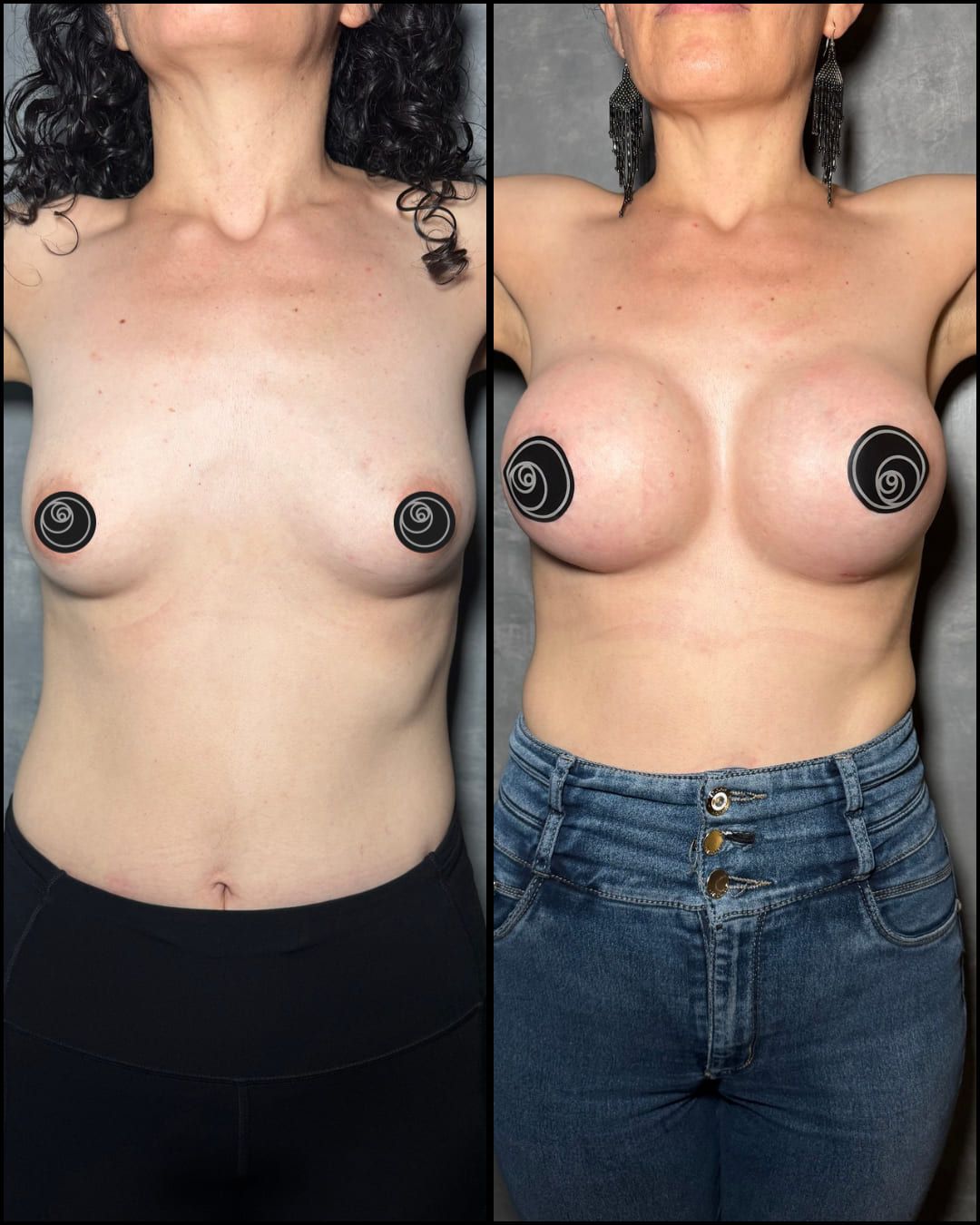 Real breast augmentation result by Dr. Castellanos