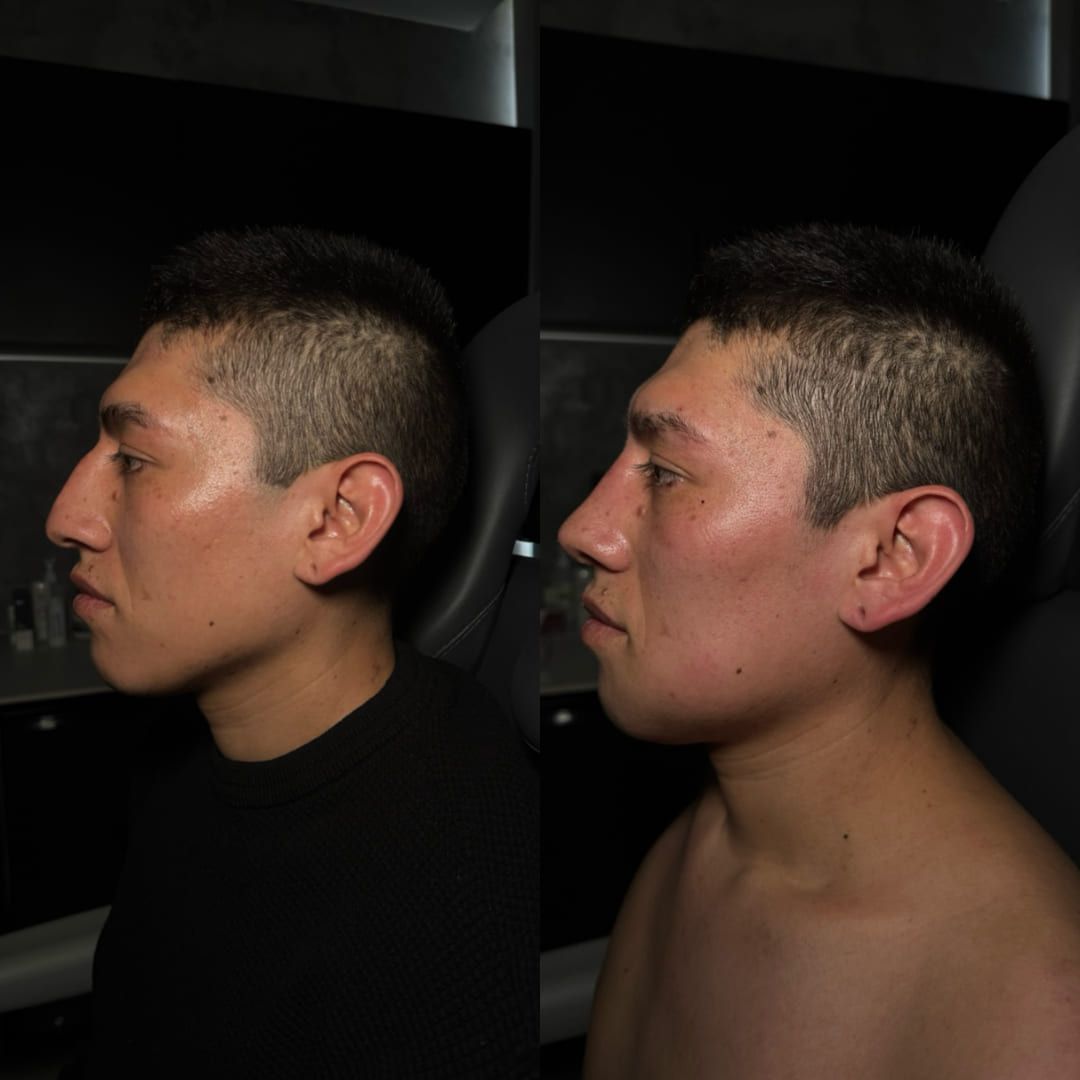 Real ear surgery result by Dr. Castellanos