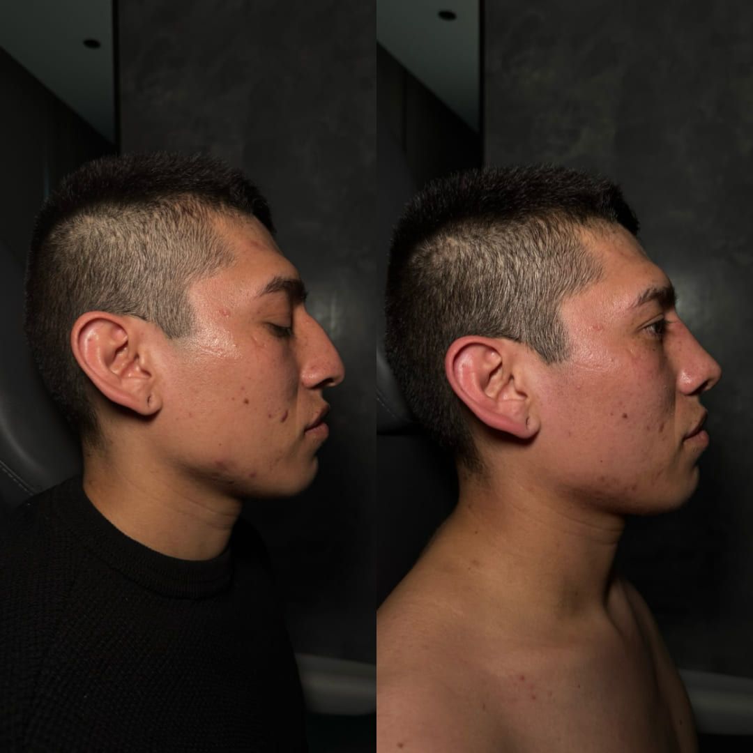 Real ear surgery result by Dr. Castellanos