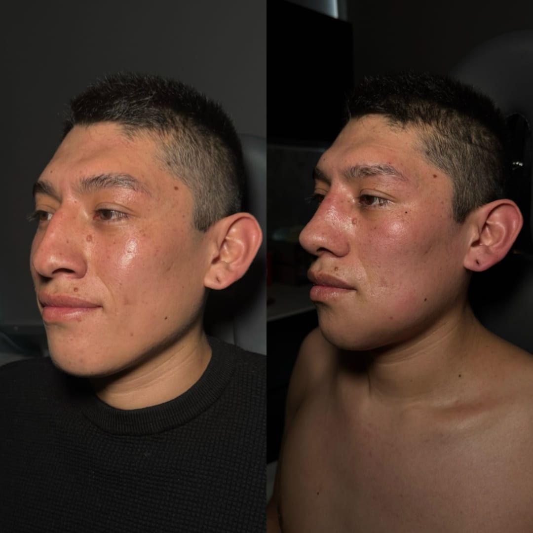 Real ear surgery result by Dr. Castellanos