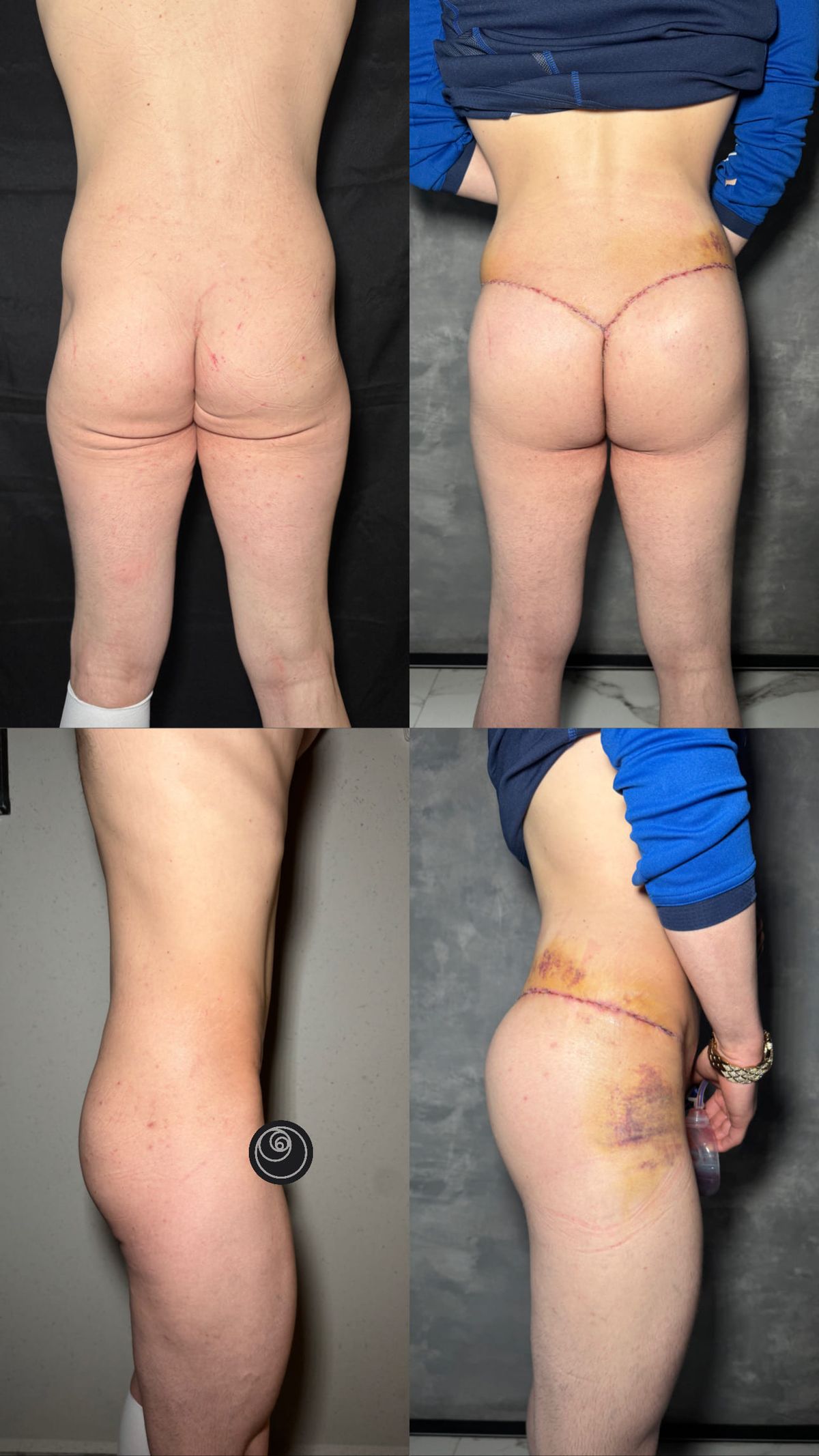 Real liposuction result by Dr. Castellanos