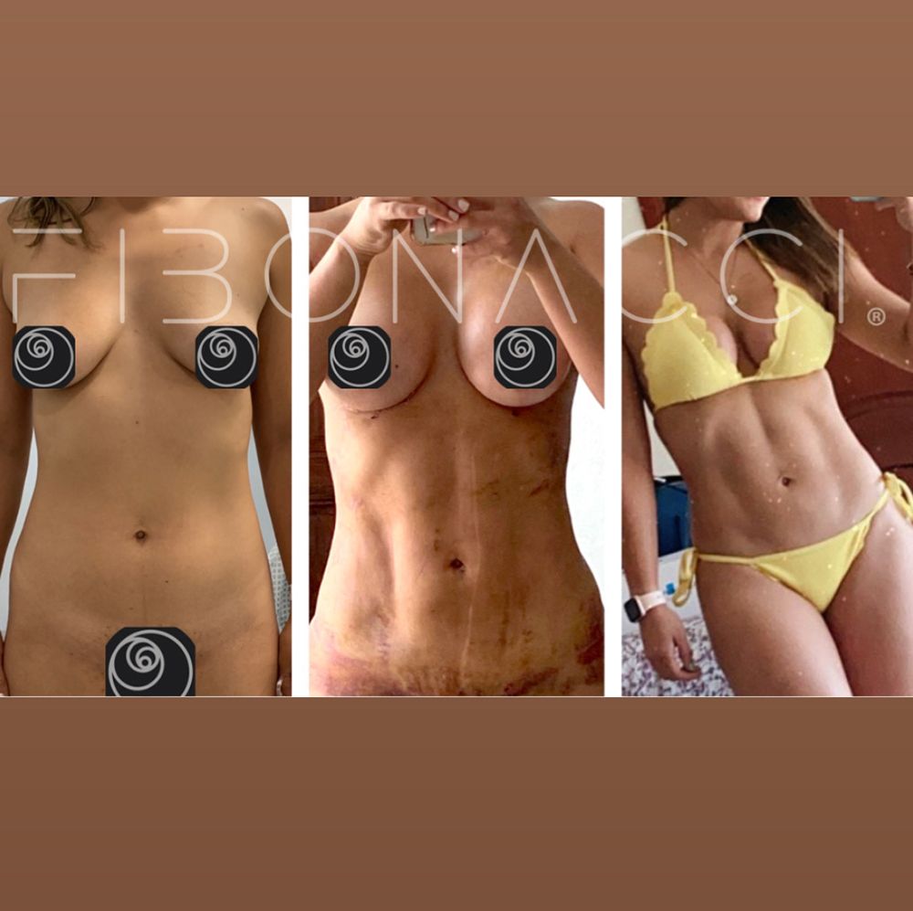 Resultado real de liposucción con el Dr. Castellanos