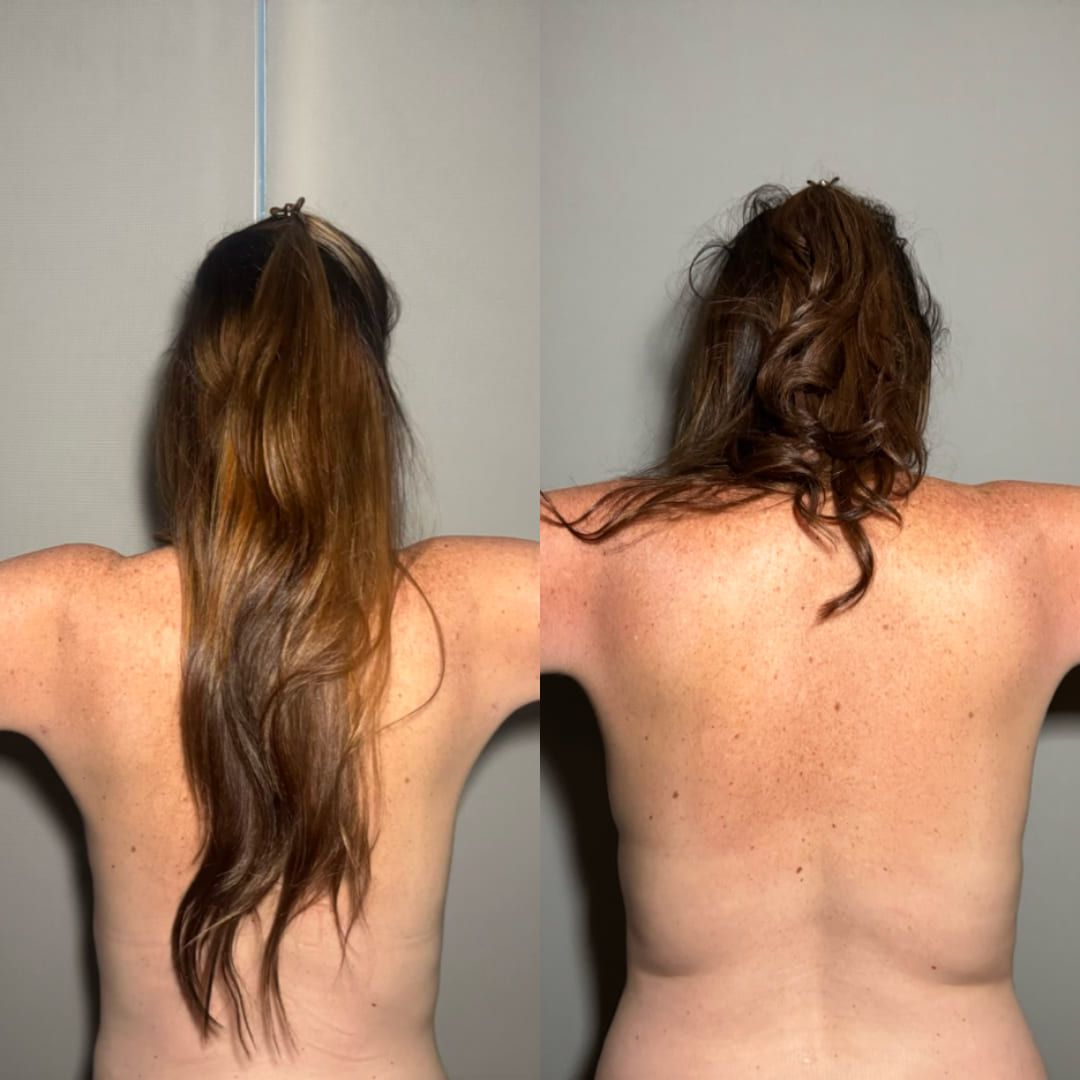 Real liposuction result by Dr. Castellanos