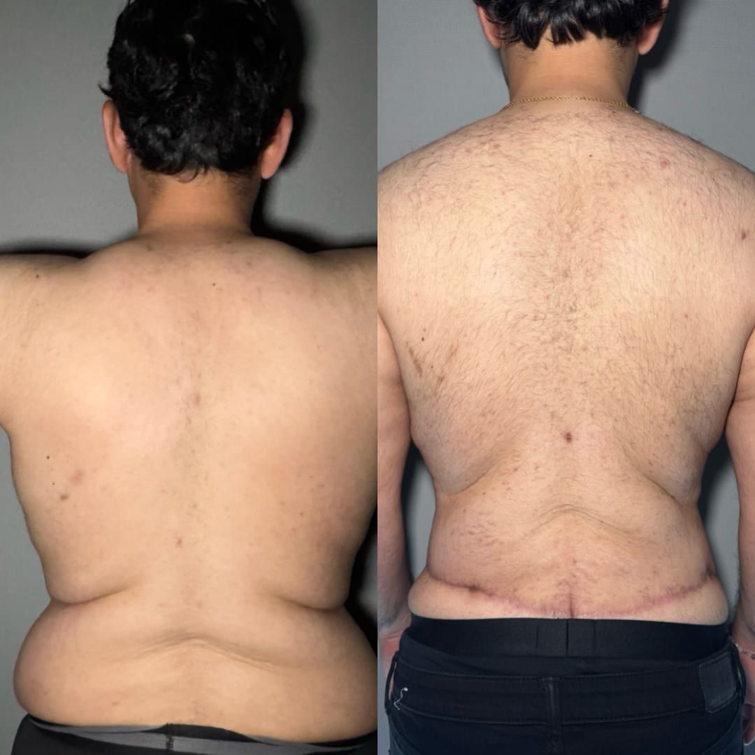 Real liposuction result by Dr. Castellanos