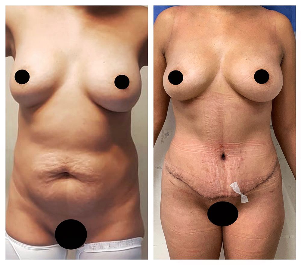 Resultado real de abdominoplastia con el Dr. Castellanos