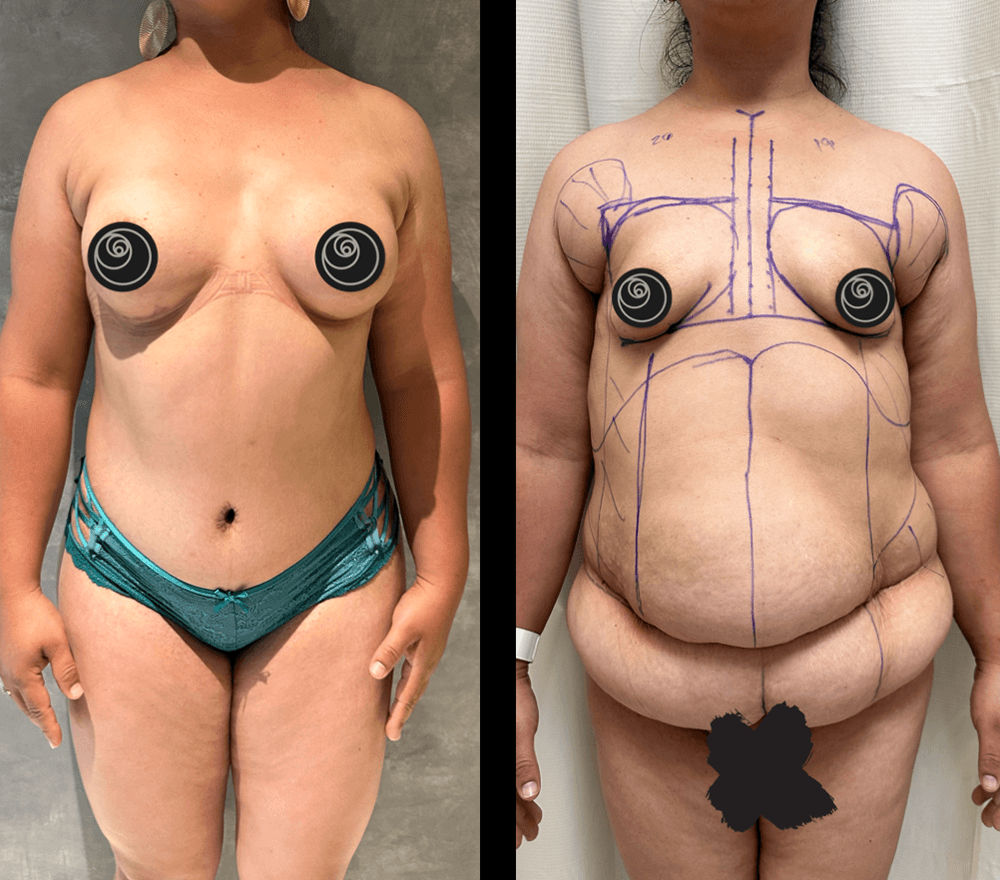 Resultado real de abdominoplastia con el Dr. Castellanos