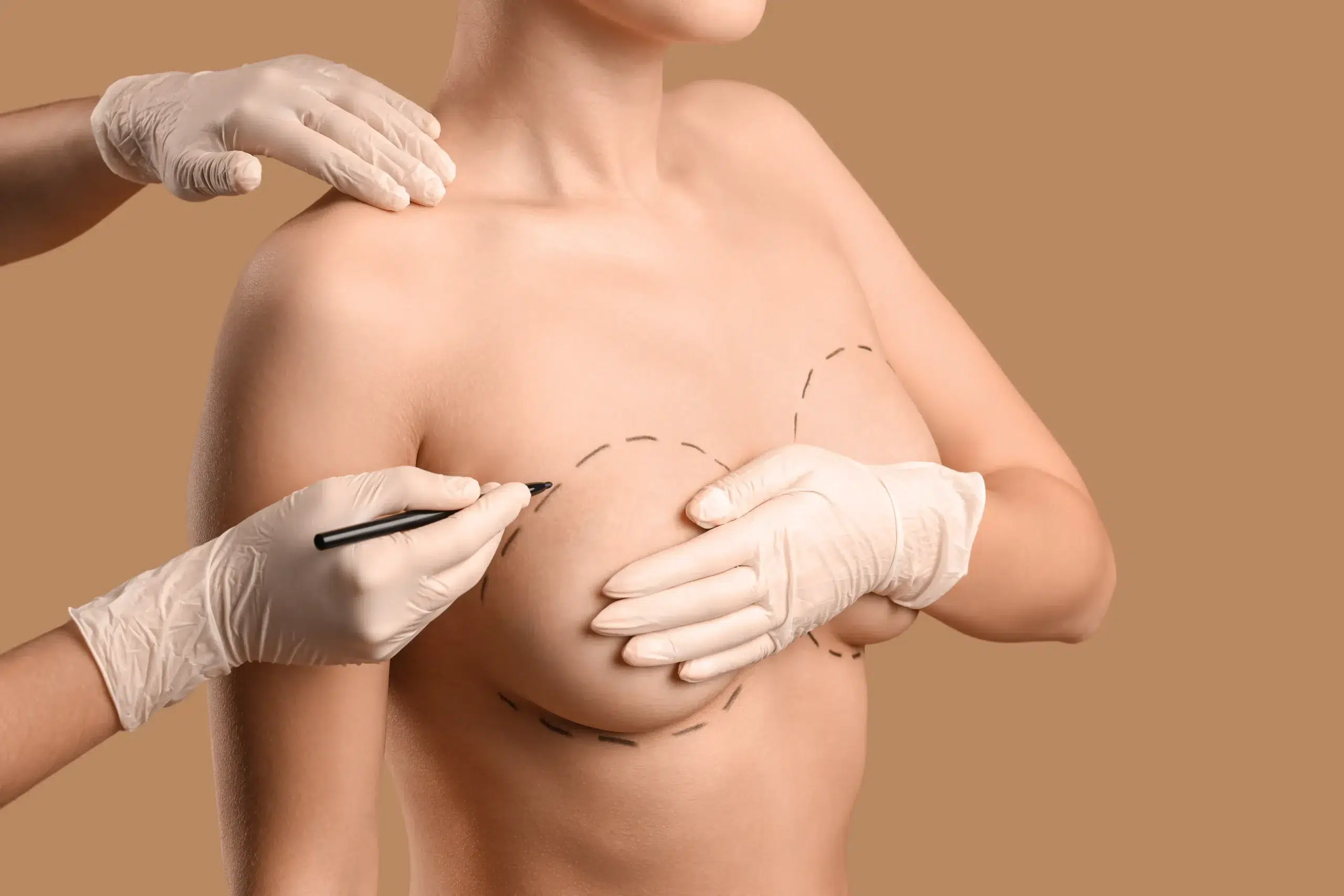 Gynecomastia Surgery