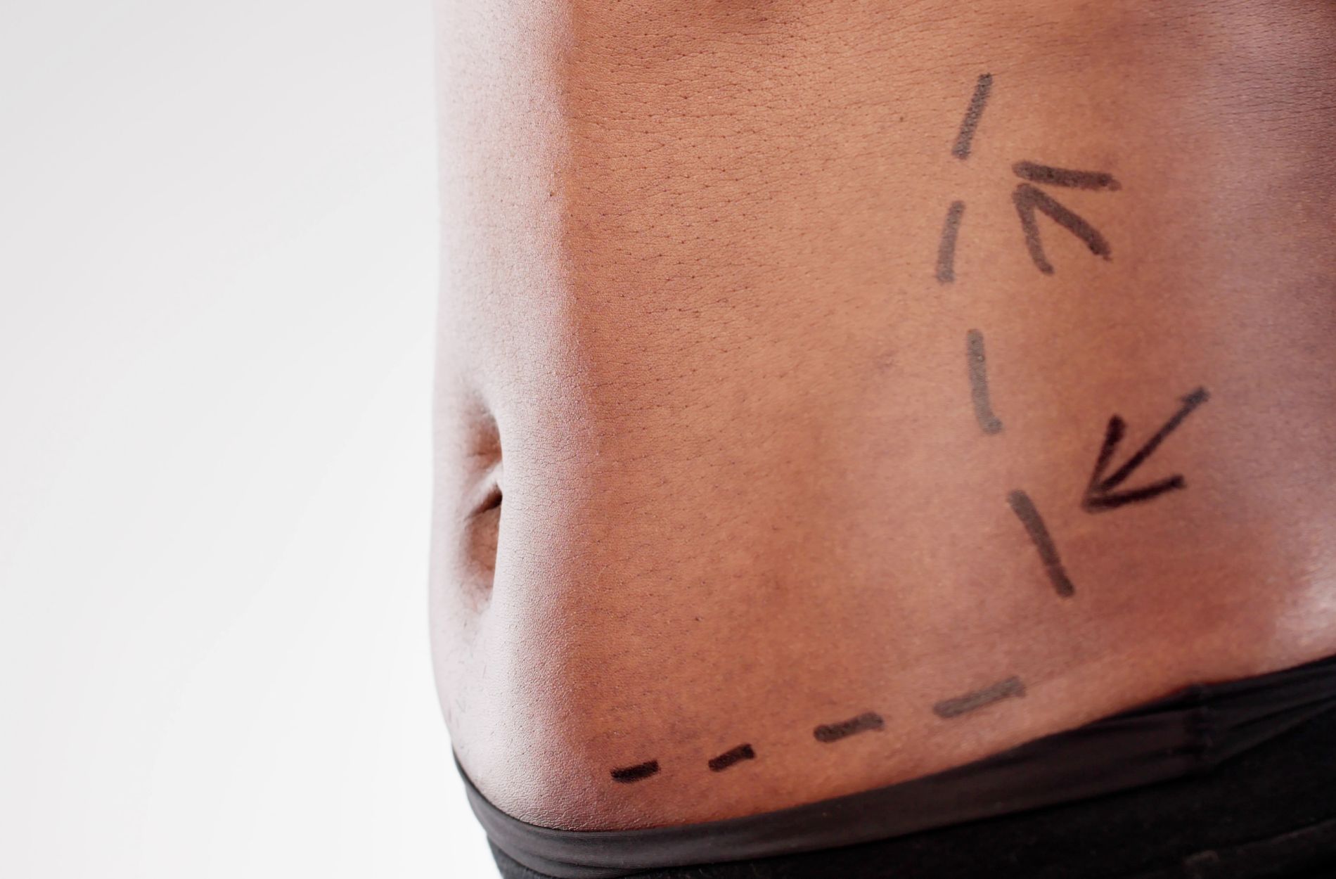 Abdominoplasty