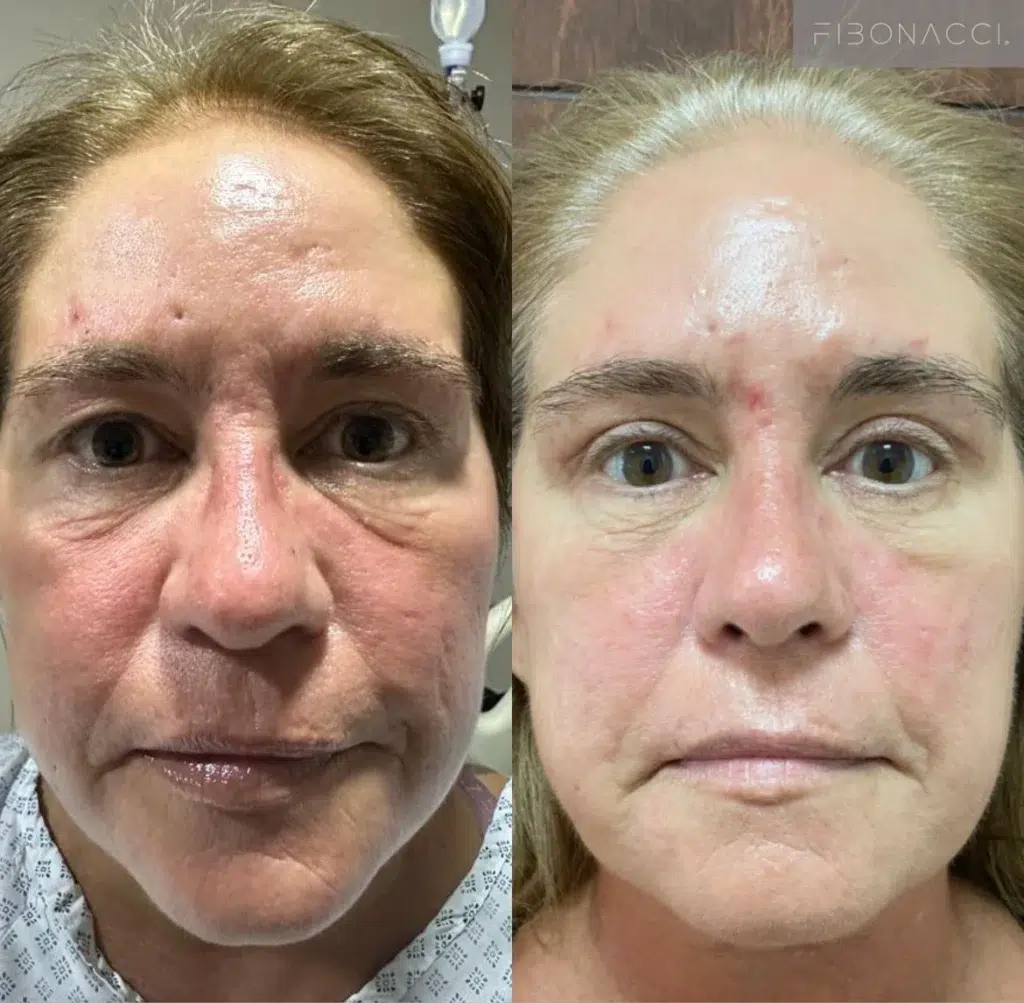 Blepharoplasty Before and After Photo by Dr. Castellanos in Zapopan Jal. Mexico