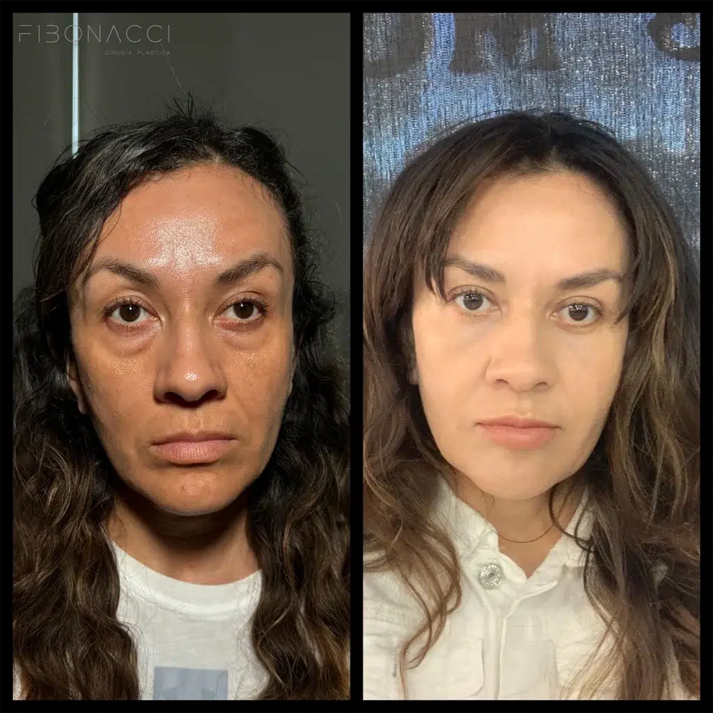 Blepharoplasty Before and After Photo by Dr. Castellanos in Zapopan Jal. Mexico