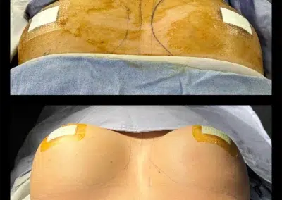 Breast Augmentation Before and After Photo by Dr. Castellanos in Zapopan Jal. Mexico