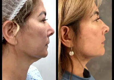 FaceTite Before and After Photo by Dr. Castellanos in Zapopan Jal. Mexico