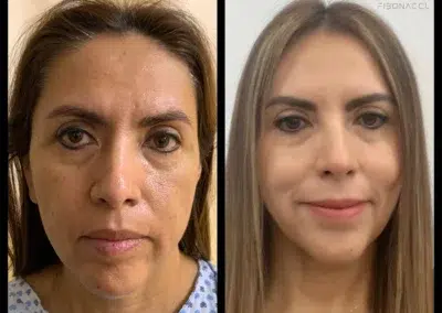 FaceTite Before and After Photo by Dr. Castellanos in Zapopan Jal. Mexico