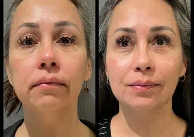FaceTite Before and After Photo by Dr. Castellanos in Zapopan Jal. Mexico