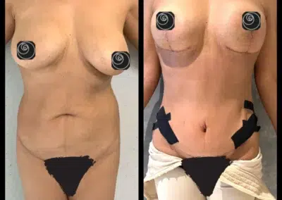 Liposculpture Before and After Photo by Dr. Castellanos in Zapopan Jal. Mexico