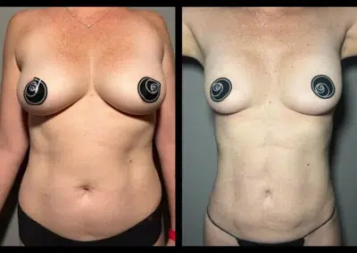 Liposculpture Before and After Photo by Dr. Castellanos in Zapopan Jal. Mexico