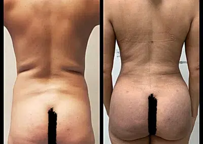 Liposculpture Before and After Photo by Dr. Castellanos in Zapopan Jal. Mexico