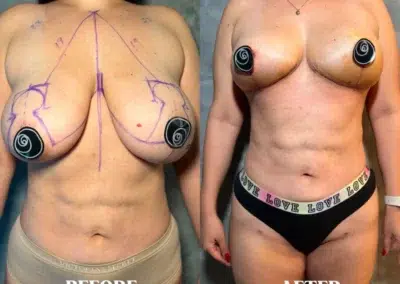 Liposuction Before and After Photo by Dr. Castellanos in Zapopan Jal. Mexico