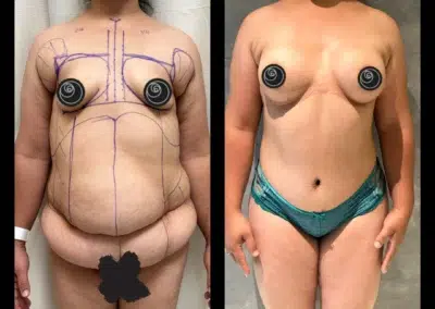 Mommy Makeover Before and After Photo by Dr. Castellanos in Zapopan Jal. Mexico
