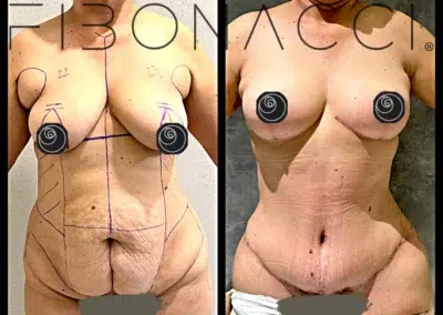 Mommy Makeover Before and After Photo by Dr. Castellanos in Zapopan Jal. Mexico