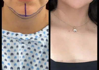 Neck Liposuction Before and After Photo by Dr. Castellanos in Zapopan Jal. Mexico
