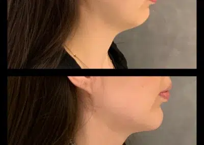 Neck Liposuction Before and After Photo by Dr. Castellanos in Zapopan Jal. Mexico